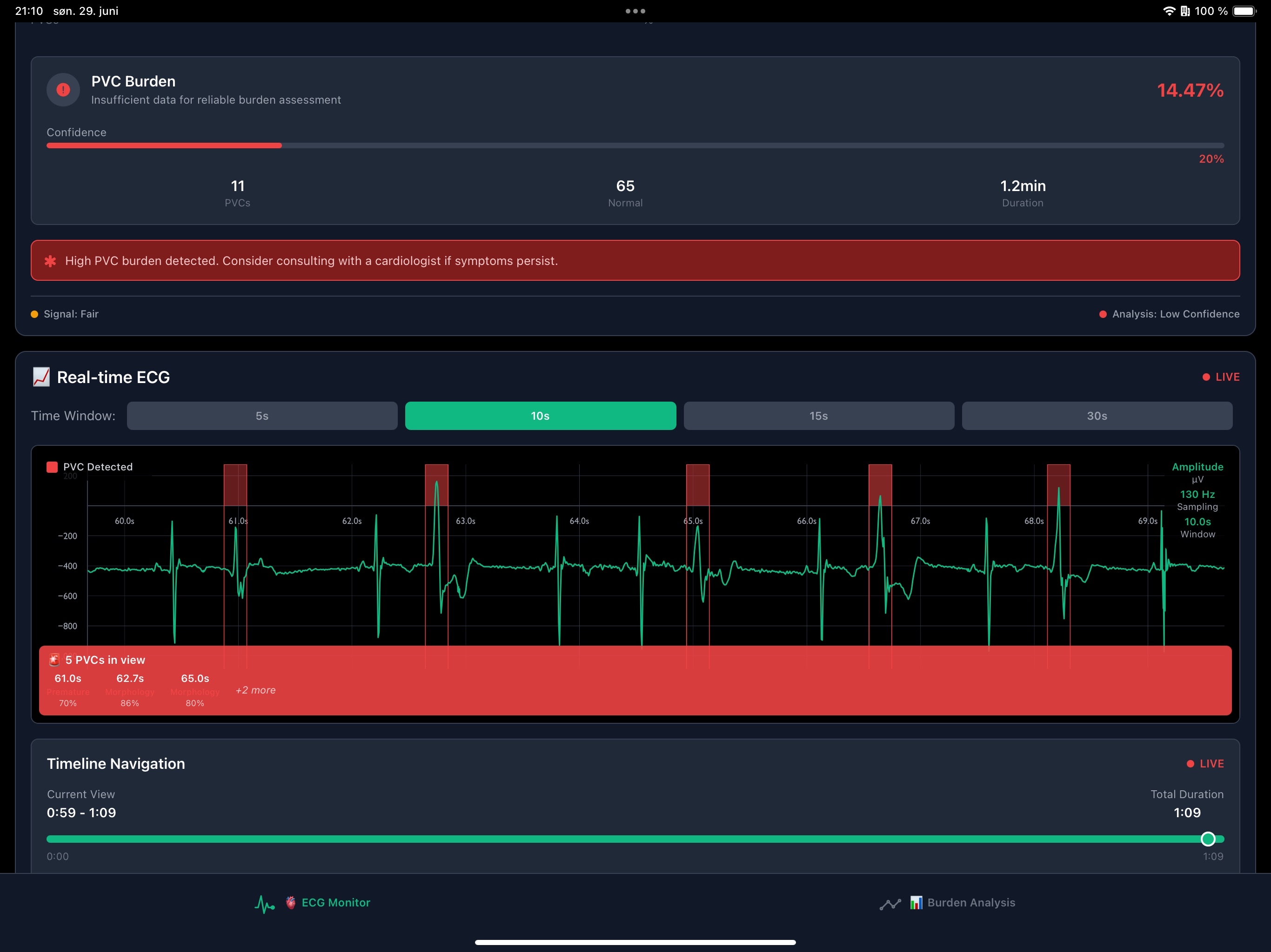 ECG Arrhythmia Detector